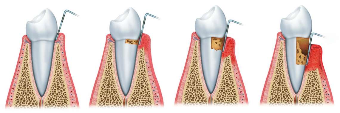 Periodonsia