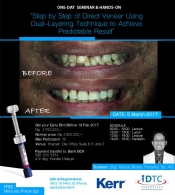 STEP BY STEP OF DIRECT VENEER USING DUAL-LAYERING TECHNIQUE TO ACHIEVE PREDICTABLE RESULT
