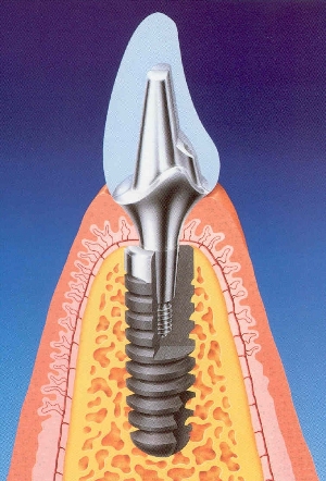Dental Implant, the best alternative to replace your missing tooth/teeth...